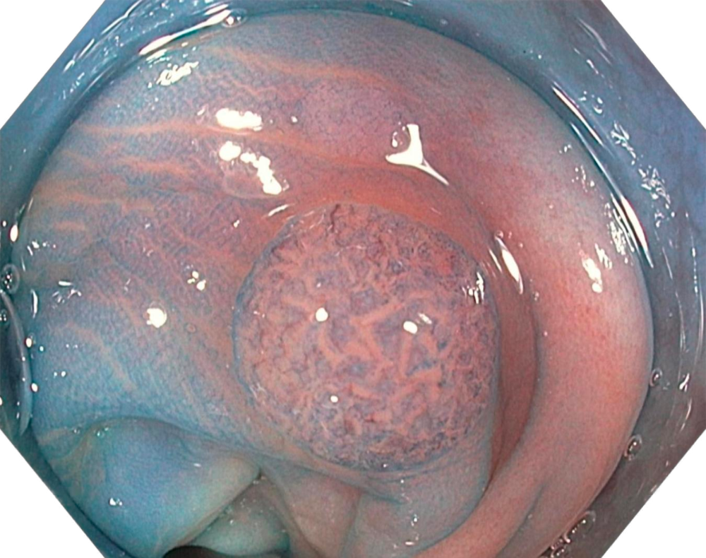 Chromo Polyp
