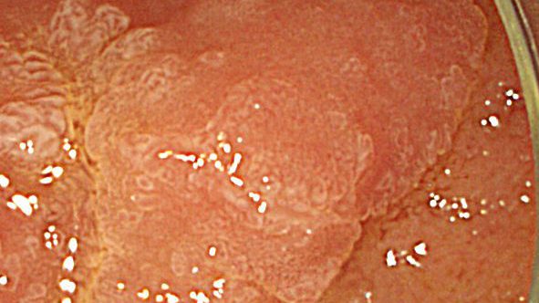 duodenal polyp seen in HDWL