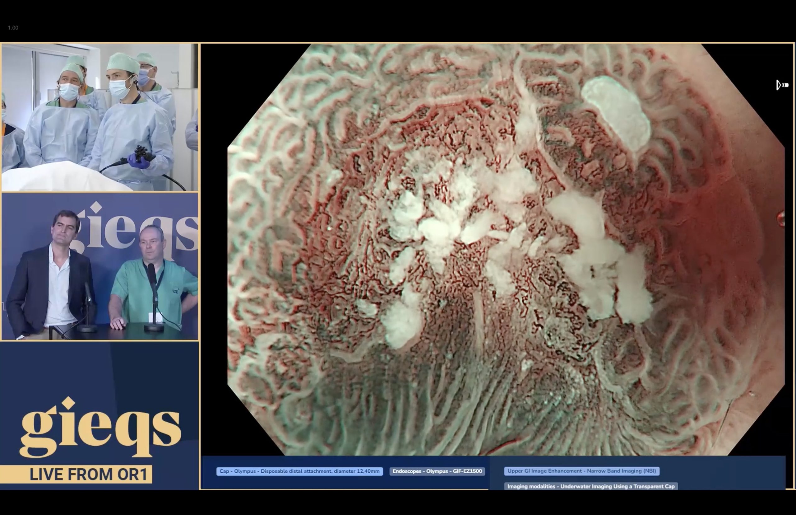 GIEQs III shot of imaging an early oesophageal cancer in Barretts oesophagus