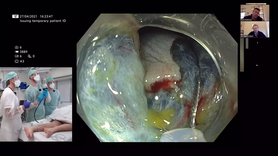 Decision Making in Colorectal Polyp Resection – Small / Intermediate