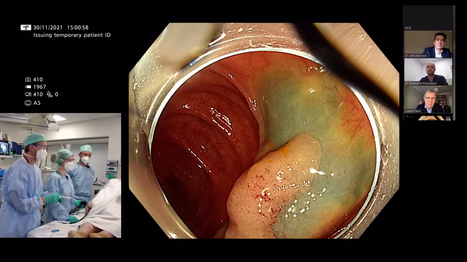 Upskilling your Polypectomy Technique