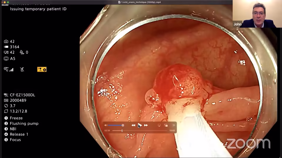 Webinar Deconstruct Polypectomy – Organised for ACPGBI