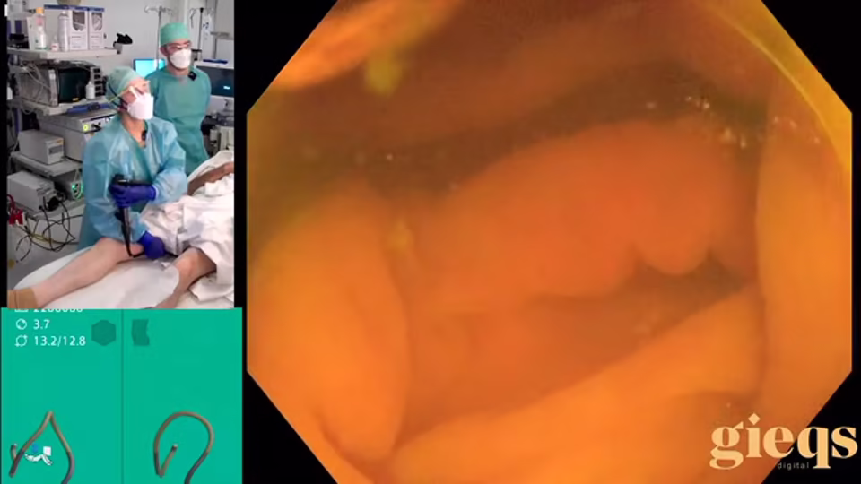 Basic Colonoscopy Course (Virtual / Live Hybrid)