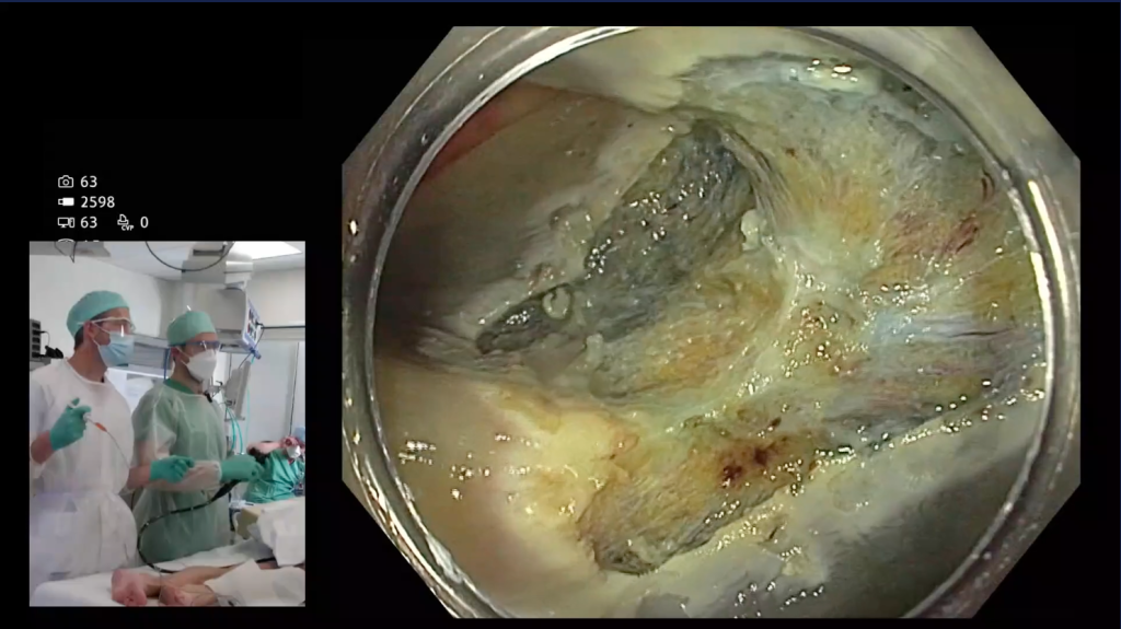 Resection defect after endoscopic mucosal resection of a large previously attempted polyp.