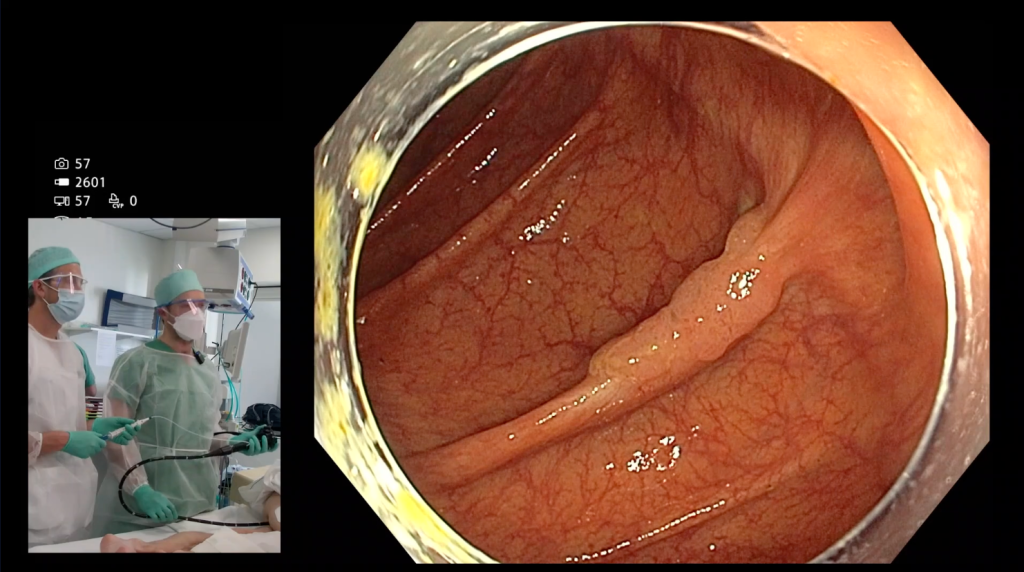A previously attempted polyp in the ascending colon.