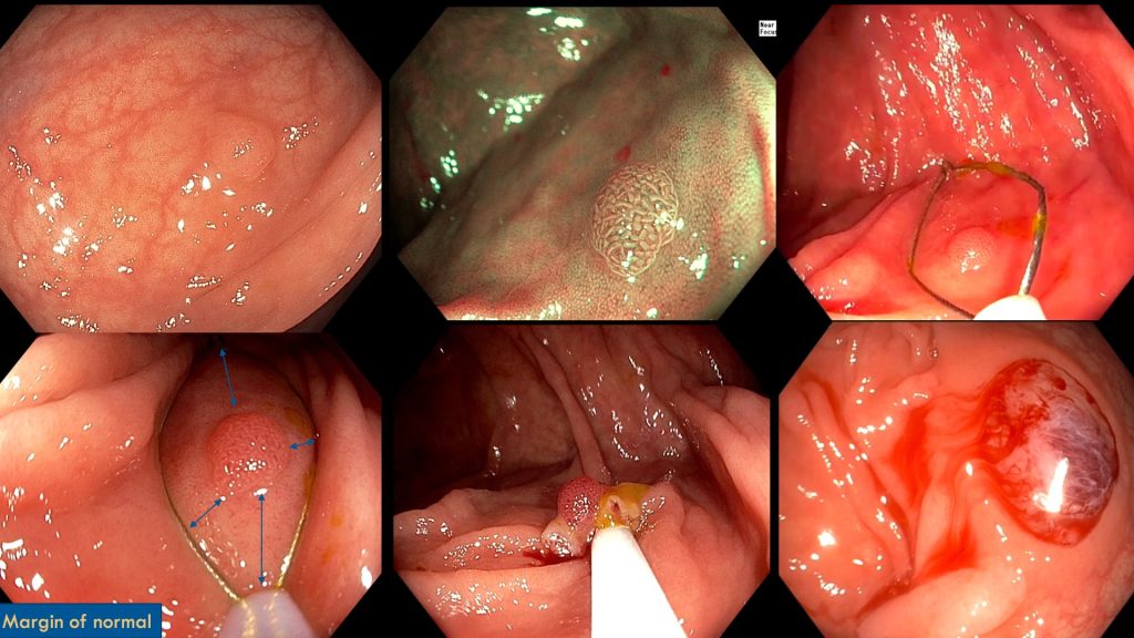An image highlighting best practice in cold snare polypectomy.