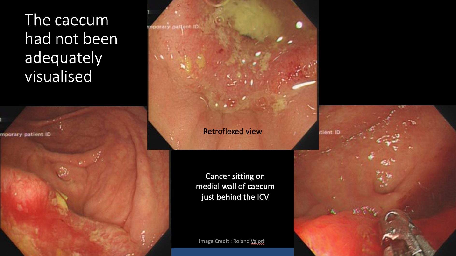 Here we see one of the potential issues with a caecal view like the first image above. The medial wall of the caecum was not visualised. This could have led to a post colonoscopy colorectal cancer for the patient like that shown in the second image.