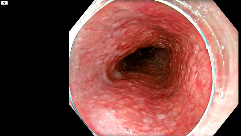 Circumferential squamous cell carcinoma of the oesophagus seen in white light
