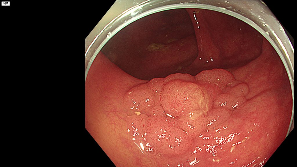 Granular polyp in the ascending colon; a target for Endoscopic Mucosal Resection