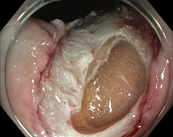 Large perforation in the colon after endoscopic mucosal resection.